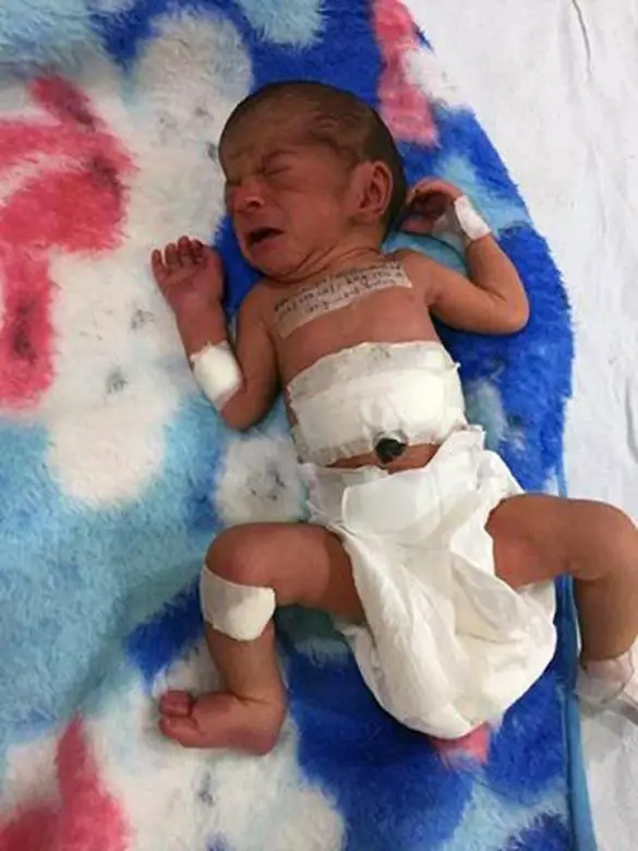 Baby Girl In India Stuns Everyone With An Extra Head Attached To Her