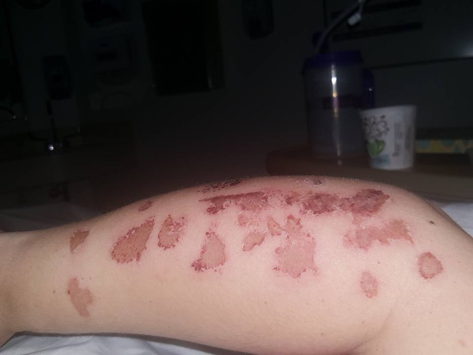 she-thought-it-was-just-a-rash-but-weeks-later-doctors-gave-her