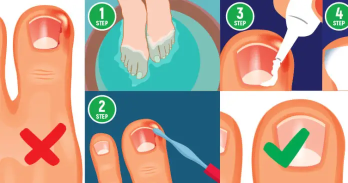 here-s-an-easier-way-to-get-rid-of-ingrown-toe-nails-without-surgery