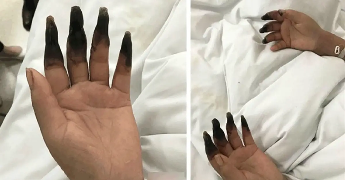Woman Has Her Fingers Turned Black After Cleaning The House