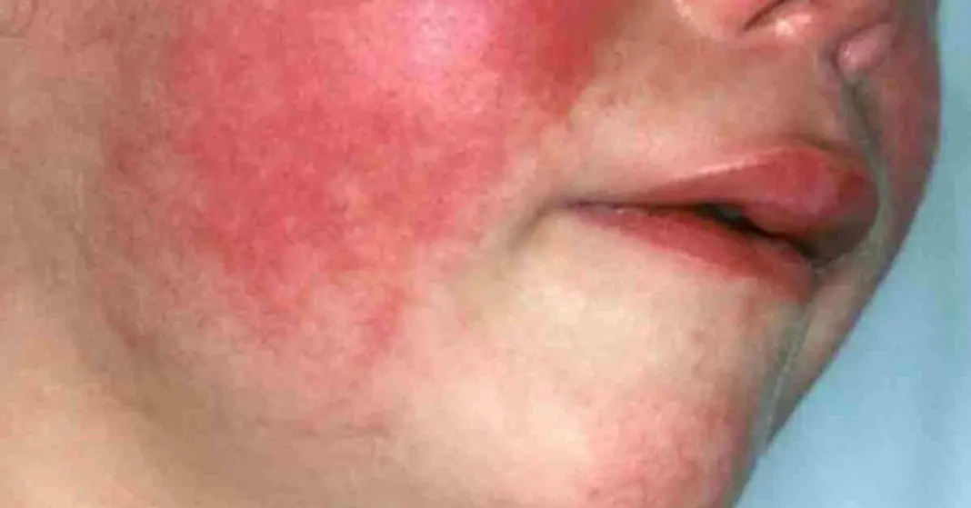 Scarlet Fever Is Making A Comeback And These Are The Warning Signs 