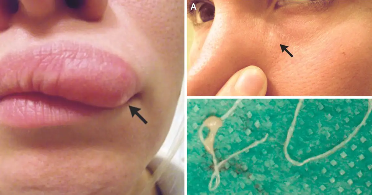 itchy-lump-on-woman-s-face-turns-out-to-be-a-6-inch-worm