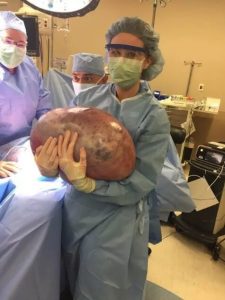 Doctors Told Woman With A Massive 50-Pound Ovarian Cyst To Just Lose Weight