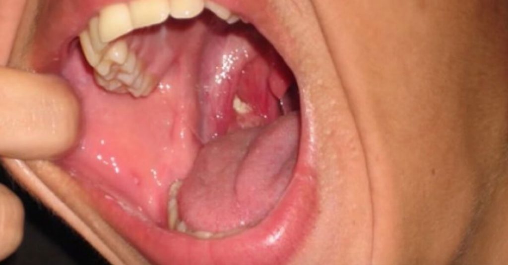 Woman s Tonsil Stones Lead To Chronic Bad Breath