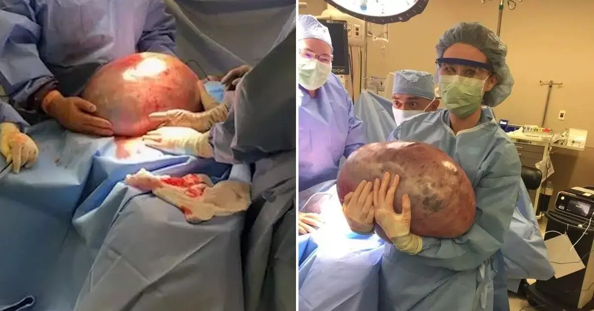 Doctors Told Woman With A Massive 50Pound Ovarian Cyst To