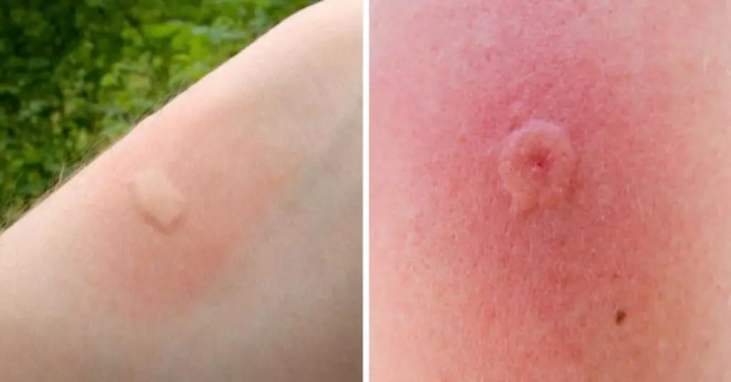 do flea bites itch more than mosquito bites