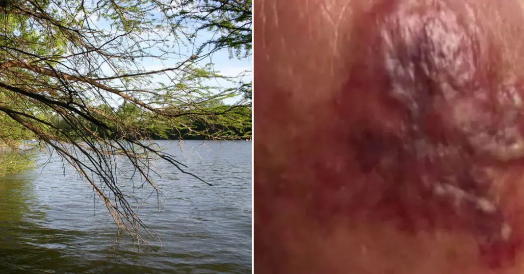 Warning Issued After Flesh-Eating Bacteria Is Showing Up All Over Town