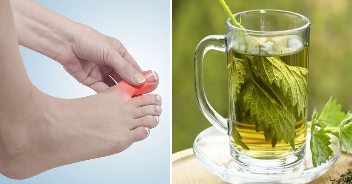 10 Natural Remedies That Can Help Alleviate Your Gout Symptoms   Natural Remedies Gout 