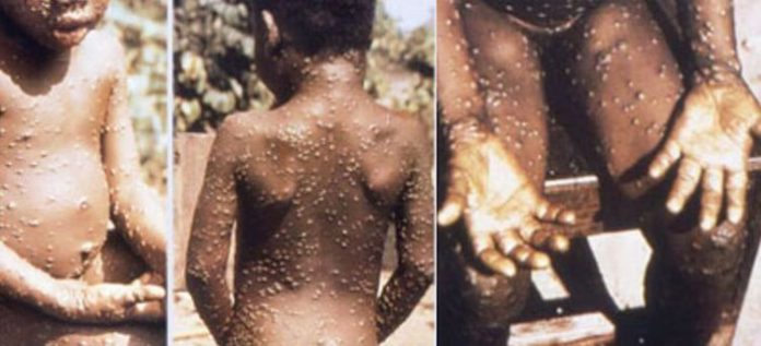 Rare Monkeypox Virus Has Started Reappearing