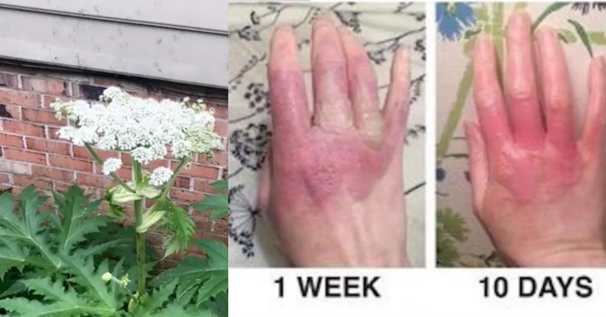 Hogweed Plant That Causes Severe Burns & Blindness Is Sweeping America